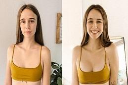 How to Choose the Right Breast Augmentation Implants Before & After clinic Dubai & Abu Dhabi