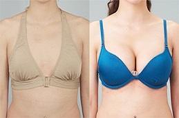 How to Choose the Right Breast Augmentation Implants Before & After in Dubai