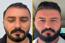 How to Prepare for Your First Hair Transplant Consultation Before & After ,
