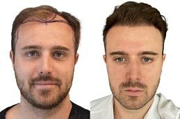 How to Prepare for Your First Hair Transplant Consultation Before & After Dubai