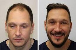 How to Prepare for Your First Hair Transplant Consultation Before & After clinic Dubai