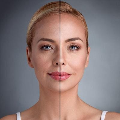 Nanofat Injection Under Eyes Dubai