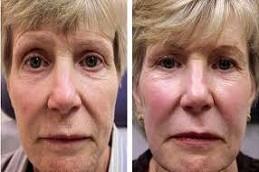 Nithya Collagen Injection Before & After Clinic in Dubai