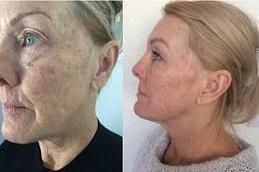 Nithya Collagen Injection Before & After Dubai