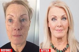 Nithya Collagen Injection Before & After Dubai,