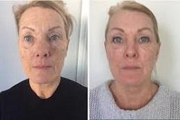 Nithya Collagen Injection Before & After in Dubai