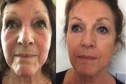 Nithya Collagen Injection Before & After