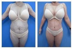 Result OF Waist Sculpting Dubai