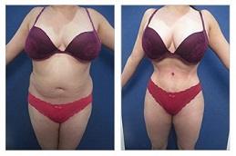 Result OF Waist Sculpting clinic in Dubai