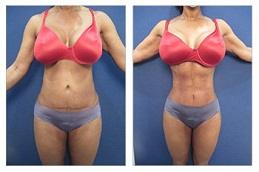 Result OF Waist Sculpting in Dubai