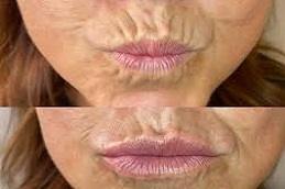 Result of The Science Behind Effective Lip Filler Treatments Dubai