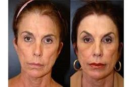 Result of The Science Behind Effective Lip Filler Treatments clinic in Dubai