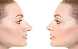 Results OF Alarplasty Cost Dubai