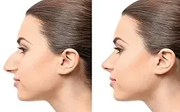 Results OF Alarplasty Cost clinic Dubai