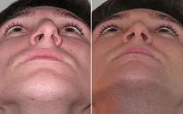 Results OF Alarplasty Cost clinic in Dubai