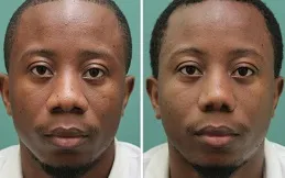 Results OF Alarplasty Cost in Dubai,