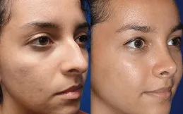 Results OF Alarplasty Cost in Dubai