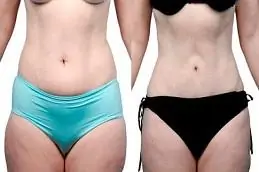 Results OF Bodytite Liposuction Cost Dubai
