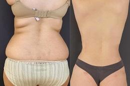 Results OF Bodytite Liposuction in Dubai