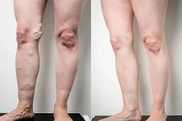 Results OF Calf Reduction Dubai