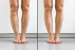 Results OF Calf Reduction clinic Dubai