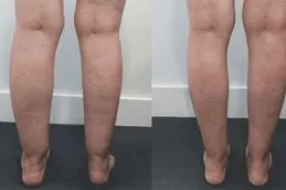 Results OF Calf Reduction clinic in Dubai