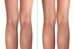 Results OF Calf Reduction cost Dubai