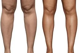 Results OF Calf Reduction cost in Dubai