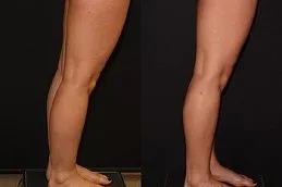 Results OF Calf Reduction in Dubai