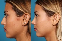 Results OF Chin Liposuction Clinic Dubai