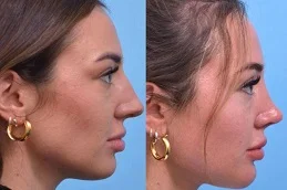 Results OF Chin Liposuction Clinic In Dubai