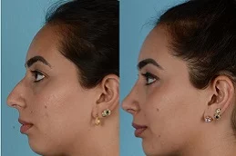 Results OF Chin Liposuction Cost Dubai