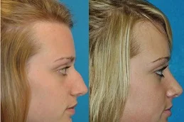 Results OF Chin Liposuction Cost In Dubai