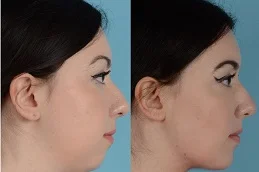 Results OF Chin Liposuction Dubai