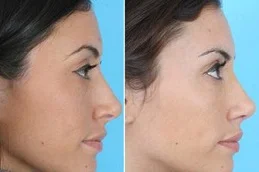 Results OF Chin Liposuction Dubai,
