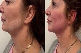 Results OF Endolift clinic in Dubai
