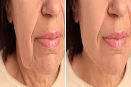 Results OF Endolift clinic in Dubai & Abu Dhabi