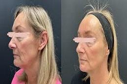 Results OF Endolift clinic in Dubai,