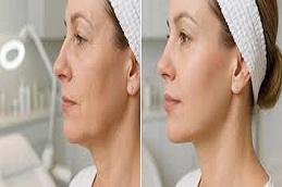 Results OF Endolift in Dubai