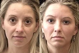 Results OF Fat Transfer Under Eyes Cost Dubai