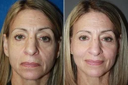 Results OF Fat Transfer Under Eyes Cost Dubai,