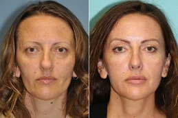 Results OF Fat Transfer Under Eyes Cost clinic Dubai
