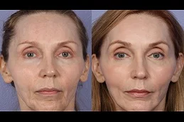 Results OF Fat Transfer Under Eyes Cost clinic in Dubai