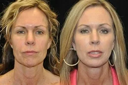 Results OF Fat Transfer Under Eyes Cost in Dubai