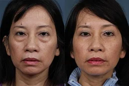 Results OF Fat Transfer Under Eyes Cost treatment Dubai