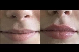Results OF Lip Augmentation Clinic in Dubai