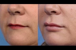 Results OF Lip Augmentation Dubai