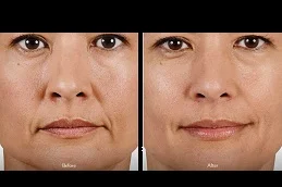 Results OF Lip Augmentation clinic Dubai