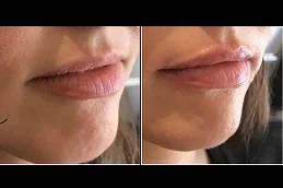 Results OF Lip Augmentation in Dubai & Abu Dhabi
