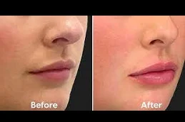 Results OF Lip Augmentation in Dubai